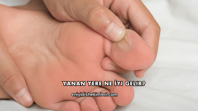 Yanan Yere Ne İyi Gelir?