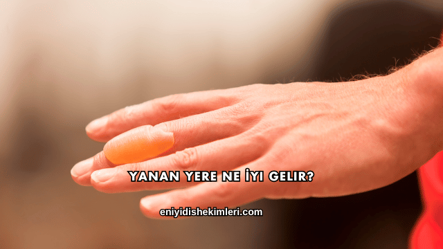 Yanan Yere Ne İyi Gelir?