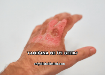 Yanığına Ne İyi Gelir?