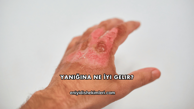 Yanığına Ne İyi Gelir?