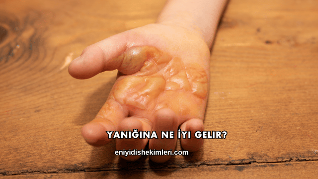 Yanığına Ne İyi Gelir?