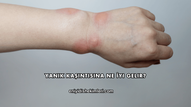 Yanık Kaşıntısına Ne İyi Gelir?