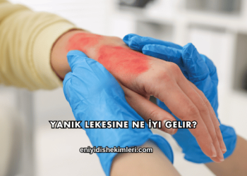 Yanık Lekesine Ne İyi Gelir?