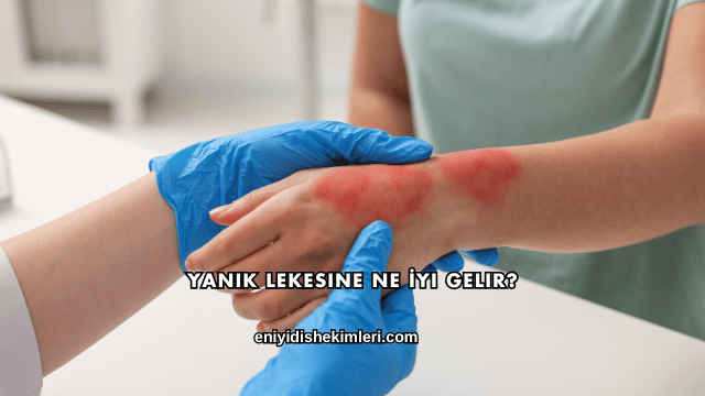 Yanık Lekesine Ne İyi Gelir?