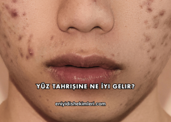 Yüz Tahrişine Ne İyi Gelir?
