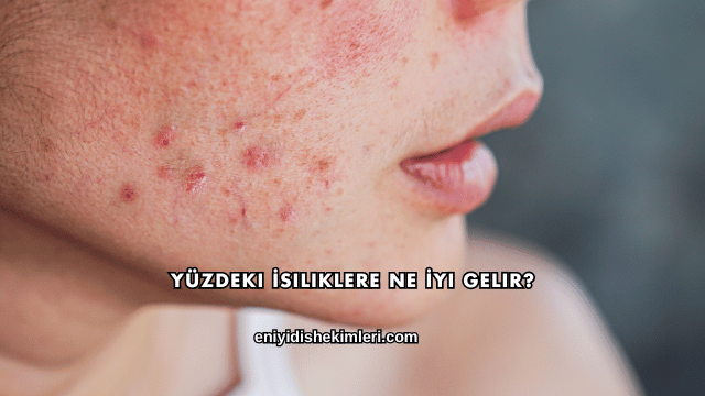 Yüzdeki İsiliklere Ne İyi Gelir?