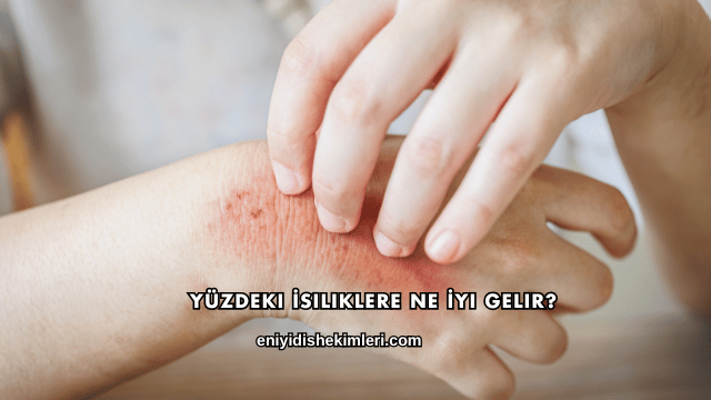 Yüzdeki İsiliklere Ne İyi Gelir?