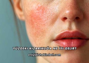 Yüzdeki Kızarıklığa Ne İyi Gelir?
