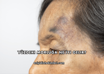 Yüzdeki Morluğa Ne İyi Gelir?