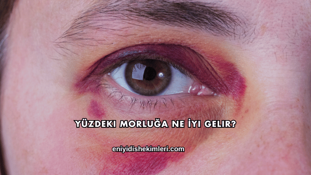 Yüzdeki Morluğa Ne İyi Gelir?