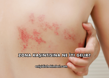Zona Kaşıntısına Ne İyi Gelir?