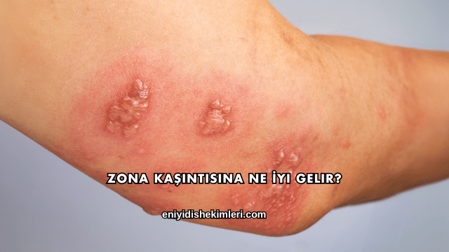 Zona Kaşıntısına Ne İyi Gelir?