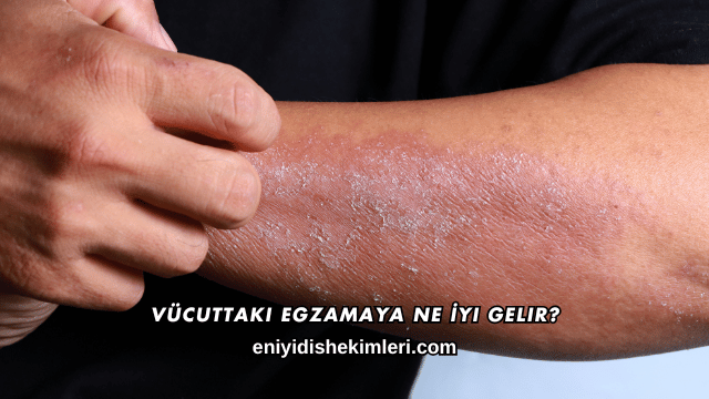 Vücuttaki Egzamaya Ne İyi Gelir?