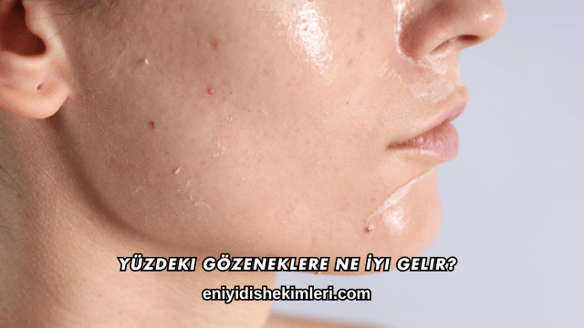 Yüzdeki Gözeneklere Ne İyi Gelir?